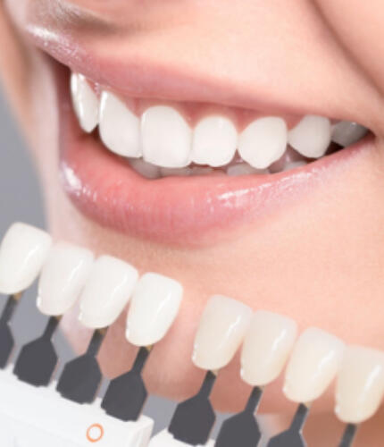 Weißere Zähne mit dem Smartphone - professionelles Bleaching
